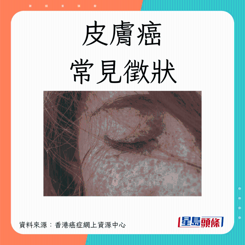 SKINCANCER_B01 SKINCANCER_B01