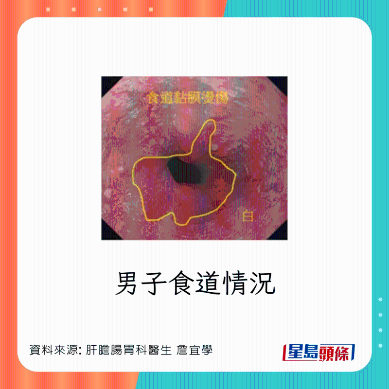 男患者食道灼傷，可惡化成食道癌