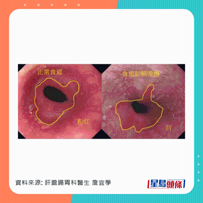 男患者食道灼傷，可惡化成食道癌