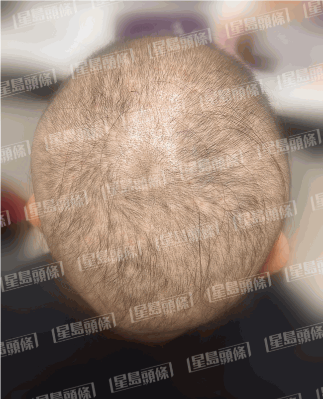 脫髮女子治療一個星期後的進度。（相片由註冊中醫師陳嬿珺提供）