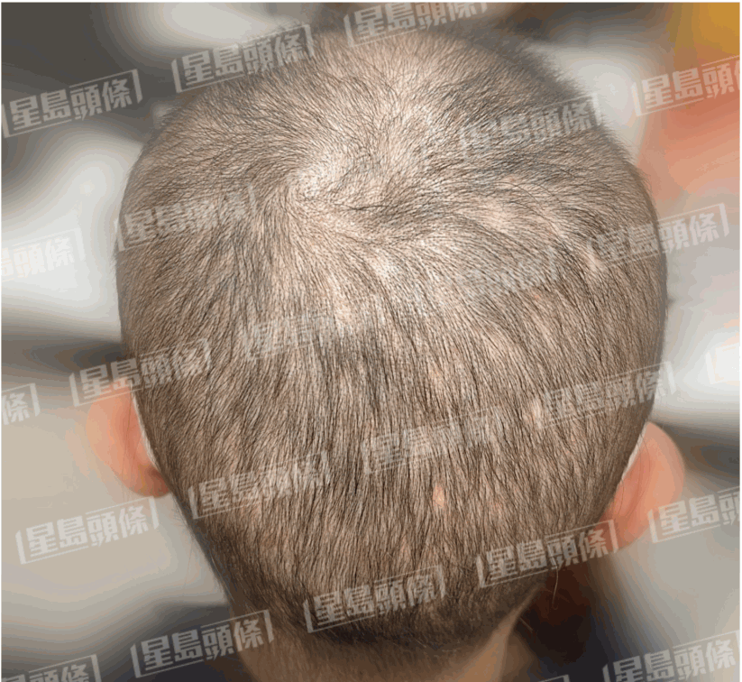 脫髮女子治療兩個星期後的進度。（相片由註冊中醫師陳嬿珺提供）