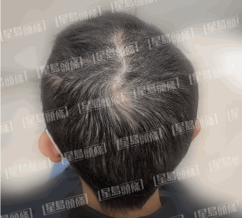 脫髮女子治療一個月後的進度，重新長回濃密頭髮，禿頭消失，回復健康。（相片由註冊中醫師陳嬿珺提供）