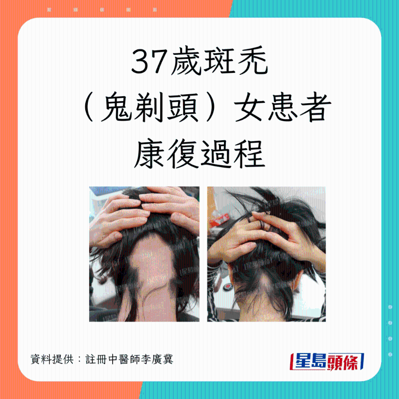 37歲斑禿（鬼剃頭）女患者康復過程
