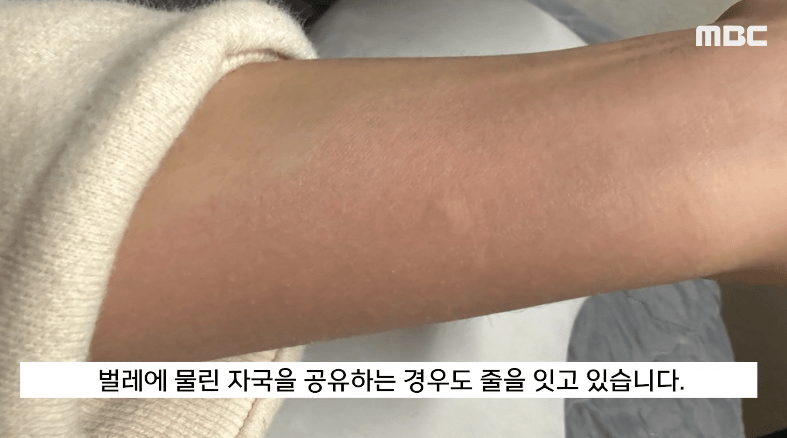 被叮咬后皮膚變得紅腫（影片截圖：MBC）