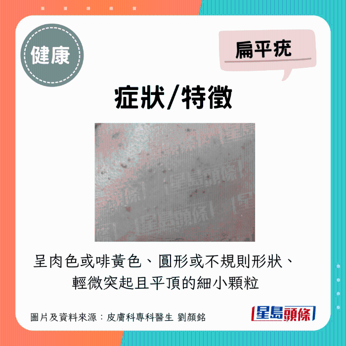 扁平疣癥狀 扁平疣癥狀