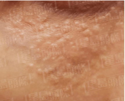 汗管瘤癥狀 汗管瘤癥狀