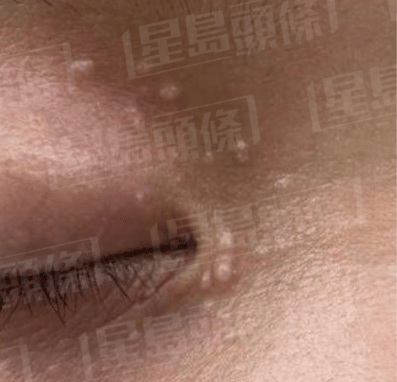 粟粒疹癥狀 粟粒疹癥狀