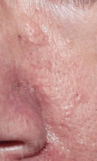 皮脂腺增生 癥狀 皮脂腺增生 癥狀