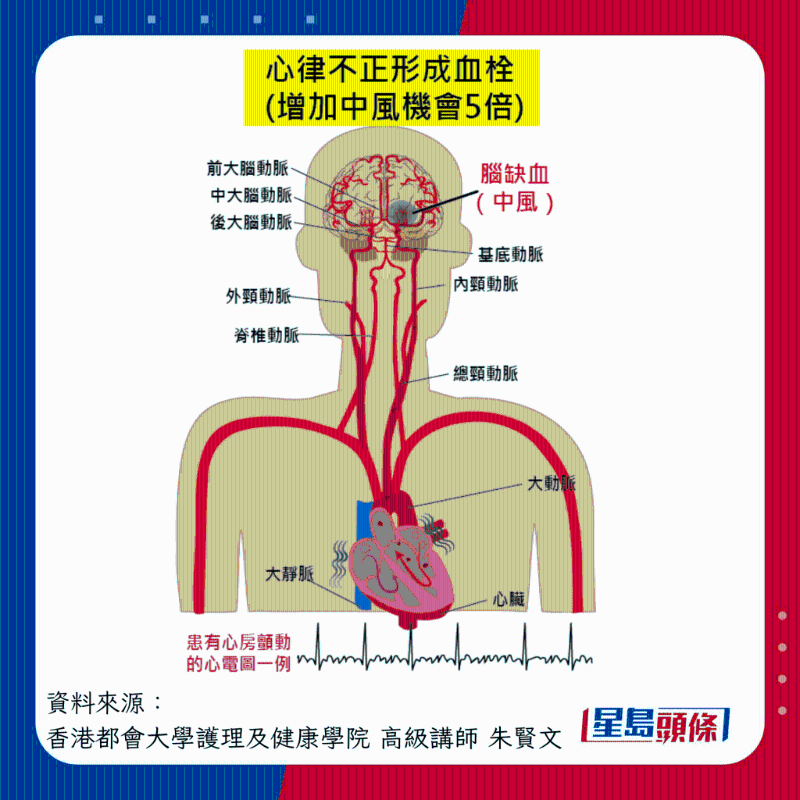 心率不正增加中風風險 心率不正增加中風風險