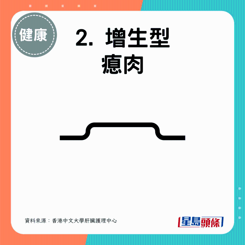 增生型息肉 增生型息肉