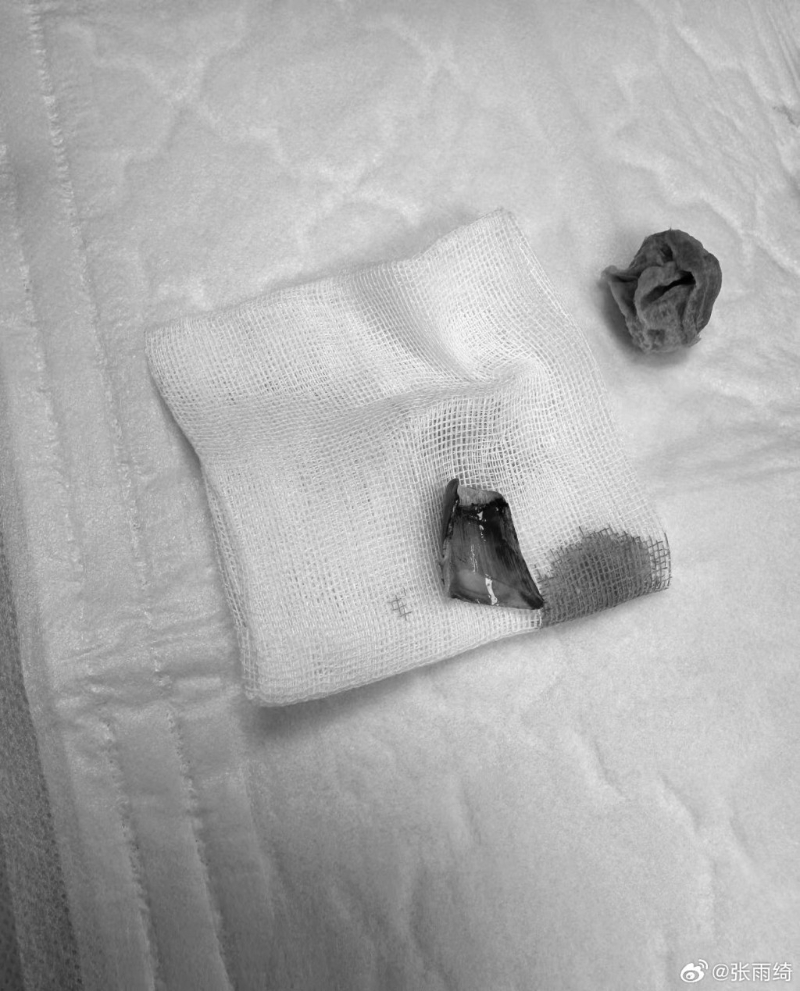 “星女郎”張雨綺坐輪椅代步5 “星女郎”張雨綺坐輪椅代步5