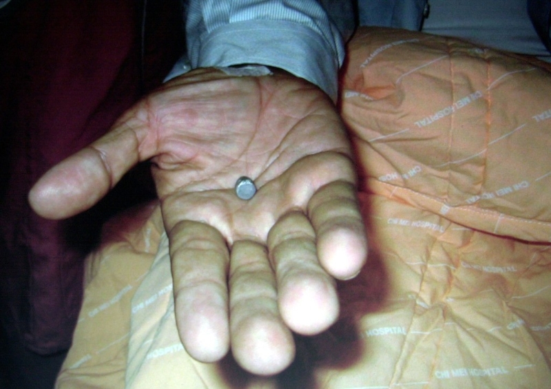 奇美醫院發布照片﹐展示陳水扁身體和衣服之間發現的彈頭。 美聯社