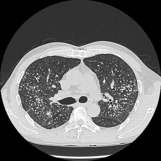 該男子長滿肺結節 該男子長滿肺結節