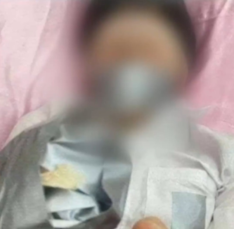 男童尾指遭割斷。