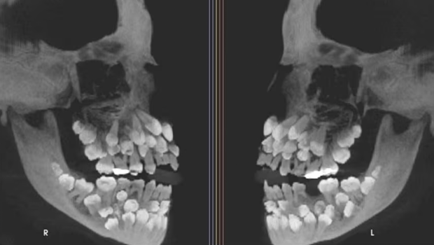 11歲女童口內驚現81顆牙 11歲女童口內驚現81顆牙